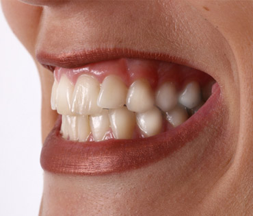 Beschwerden durch Zähneknirschen oder Zähnepressen